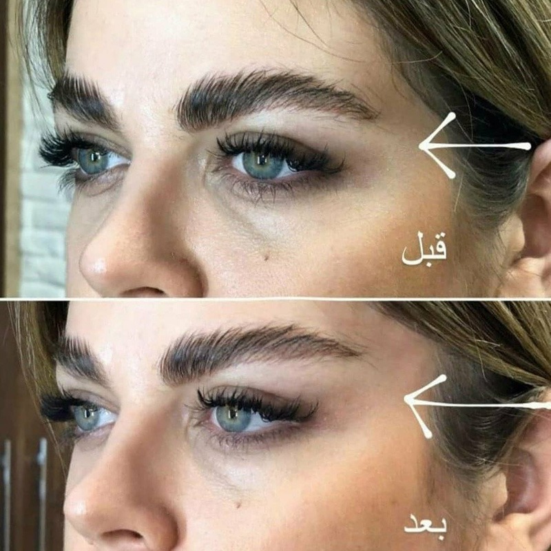 کش لیفت ابرو و شقیقه